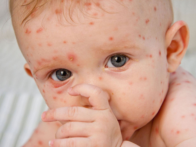 rubella bẩm sinh