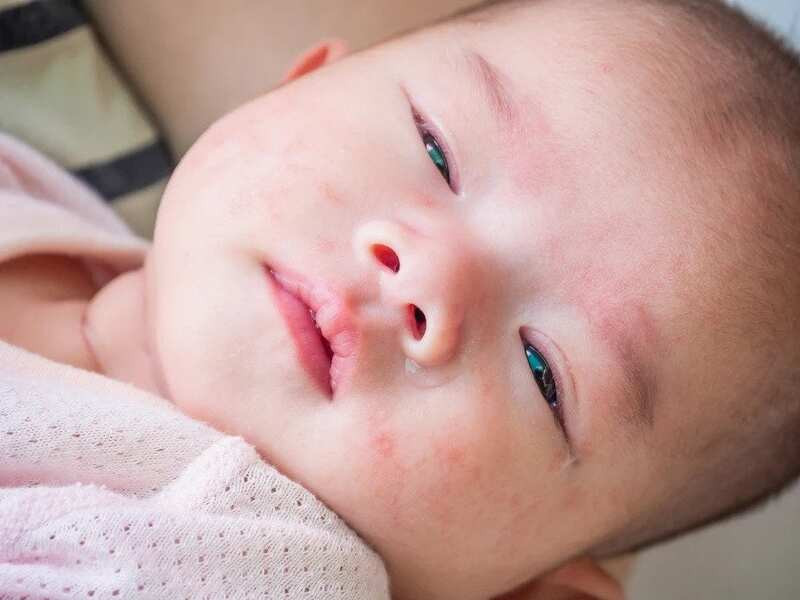 dị ứng ở trẻ
