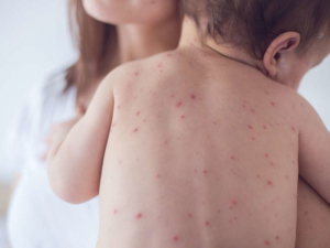 rubella