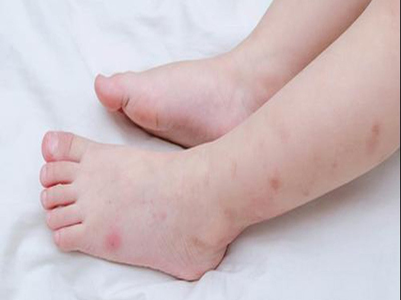 trẻ bị dị ứng