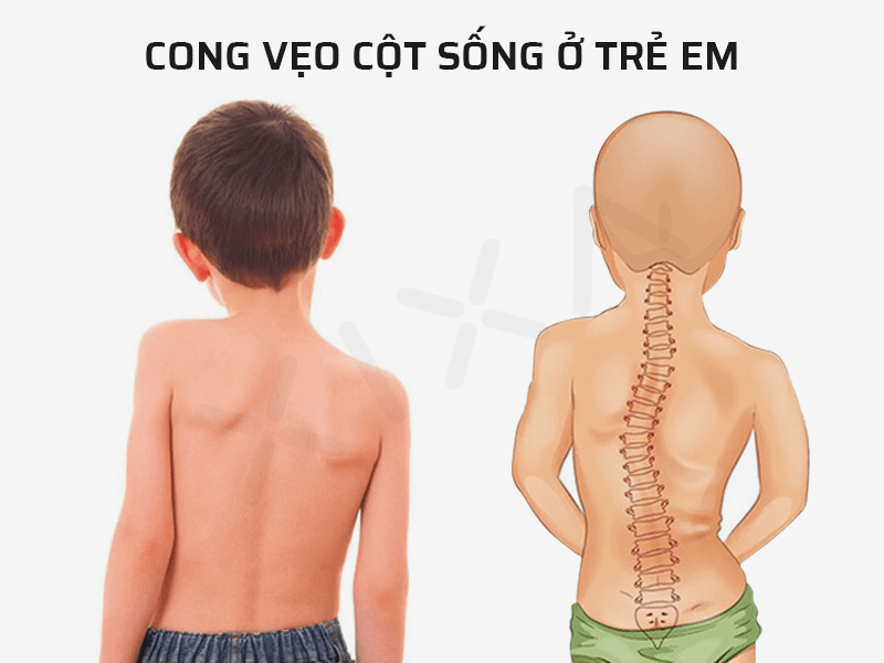 cong vẹo cột sống ở trẻ