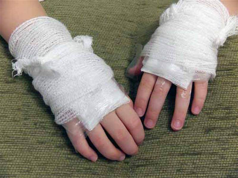 phòng tránh bị bỏng ở trẻ