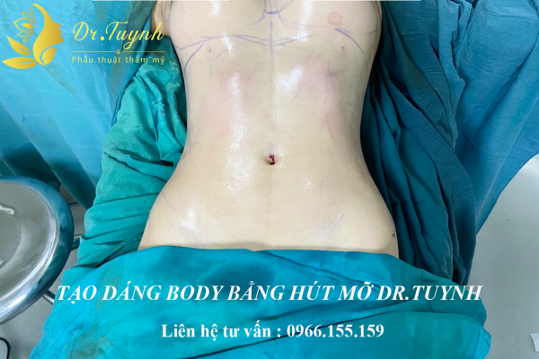 Hút mỡ có phải là phương pháp giảm cân hay không?