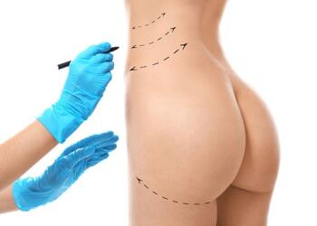 Hút mỡ bụng bơm mông - Giải pháp cho vòng 3 căng tròn quyến rũ