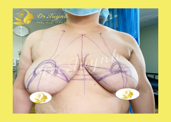 Ngực phì đại: Không còn là gánh nặng!