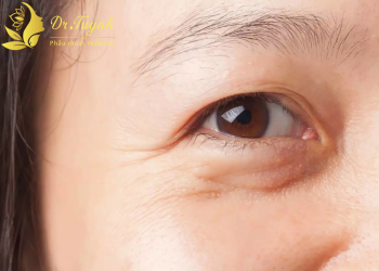 THỰC HƯ CHUYỆN GIẢM THỊ LỰC DO SỤP DA MÍ MẮT