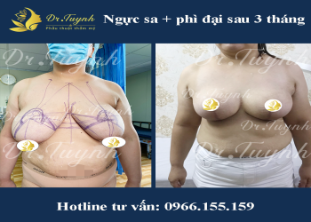 NGỰC KHỦNG CẢI THIỆN HOÀN TOÀN SAU MỘT LẦN PHẪU DUY NHẤT (BS PHAN TUYNH)