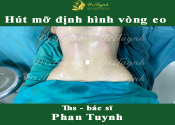 Hút mỡ bụng cần nghỉ dưỡng bao lâu?