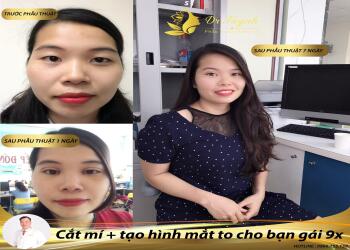 Cách chăm sóc sau cắt mí mau lành không bị sẹo (bài chia sẻ chuyên môn với đồng nghiệp thẩm mỹ)