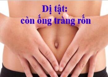 Dị tật rốn - còn ống tràng rốn (Thẩm mỹ rốn phần 4)