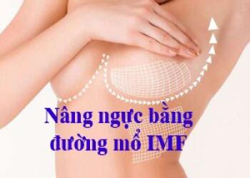 NHỮNG ƯU ĐIỂM CỦA KỸ THUẬT NÂNG NGỰC ĐƯỜNG CHÂN NGỰC (ĐƯỜNG IMF)