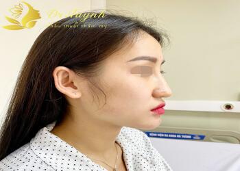 01 BIẾN CHỨNG XA THƯỜNG GẶP CỦA NÂNG MŨI: ĐẦU MŨI GỤC (Nhân 1 ca sửa mũi cảu của Bác sĩ Phan Tuynh)