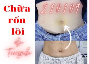 Thoát vị rốn và Thẩm mỹ rốn (Thẩm mỹ rốn phần 2)