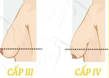 NGỰC SA TRỄ: CẢI TIẾN KỸ THUẬT MANG LẠI HIỆU QUẢ THẨM MỸ HƠN DO ÍT SẸO
