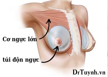 Nâng ngực đường chân ngực tại sao lại là đường phẫu được ưu tiên nhất (các dịch vụ nâng ngực: phần 1)