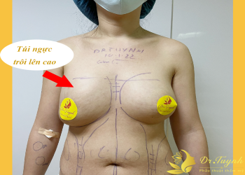 BIẾN CHỨNG NÂNG NGỰC: TÚI NGỰC QUÁ CAO