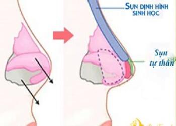 TỤT SỤN MŨI SAU NÂNG MŨI CÓ THỰC SỰ ĐÁNG SỢ?