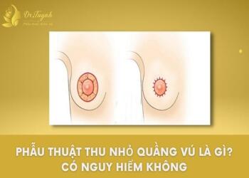ứng dụng kỹ thuật treo sa trễ quanh quầng ti cho những mức độ sa trễ nào?