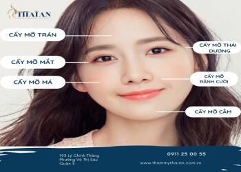 Cấy mỡ sưng bao lâu