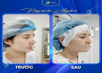SỬA MŨI GẤP DO DỌA THỦNG DA ĐẦU MŨI, MỘT CA LÂM SÀNG
