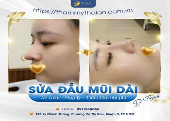sửa mũi: chỉnh sửa đầu mũi quá dài, vài điều bạn luận