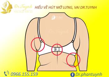 Những yếu tố quyết định chi phí cho một ca hút mỡ, bạn nên biết
