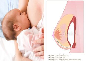 Sau phẫu thuật ngực có cho con bú được không?
