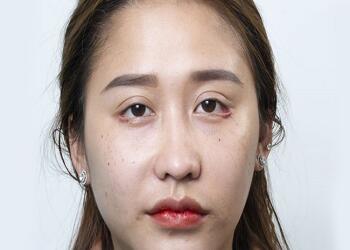 Sửa lại mí lỗi tốn kém bao nhiêu?
