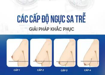 Các cấp độ sa trễ ngực và phương pháp khắc phục phù hợp