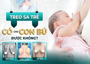 Treo sa trễ không đặt túi có cho con bú được không?