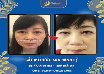 Cắt mí dưới giải quyết được những vấn đề thẩm mỹ gì?