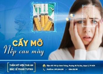 Thẩm mỹ vùng rãnh cau mày bằng cấy mỡ tự thân