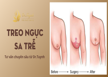 Treo ngực sa trễ - Tư vấn chuyên sâu từ bác sĩ giúp bạn lựa chọn đúng