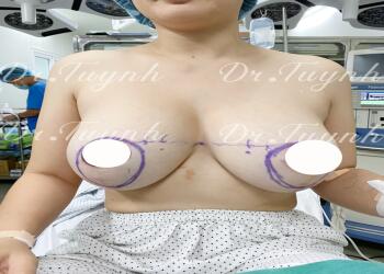 LỰA CHỌN ĐƯỜNG MỔ CHO NGỰC SA TRỄ NĂNG - ĐÒN CÂN NÃO!