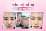 phau-thuat-cat-mi-mat