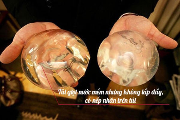 Các loại túi độn ngực hiện nay