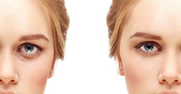 Cấy mỡ hố mắt trũng