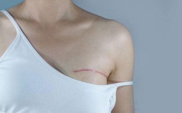chăm sóc vết thương thẩm mỹ
