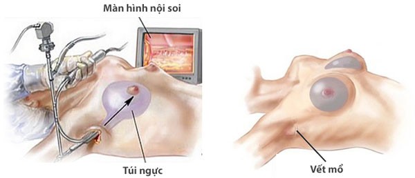 Nâng ngực nên chọn đường mổ nào?