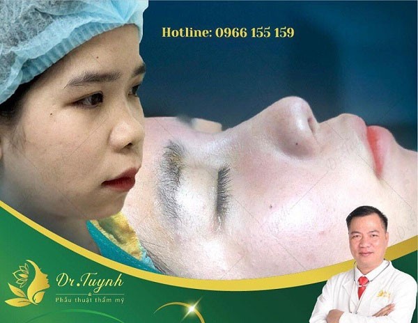 Những ưu điểm của sụn tự thân trong nâng mũi