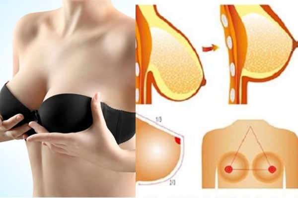 Những ưu điểm của treo vú sa trễ đường quầng vú