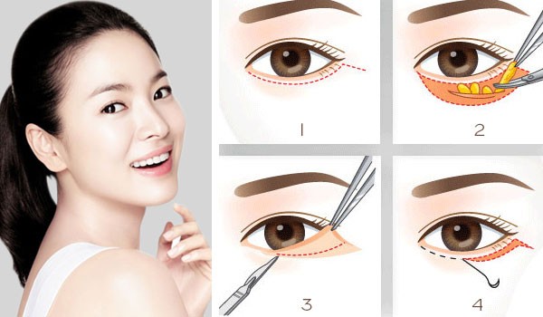 phẫu thuật cắt mí dưới