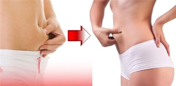 Phẫu thuật tạo hình thành bụng tối thiểu (mini)