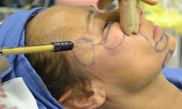 Quy trình cấy mỡ