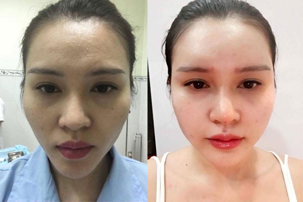 Quy trình cấy mỡ