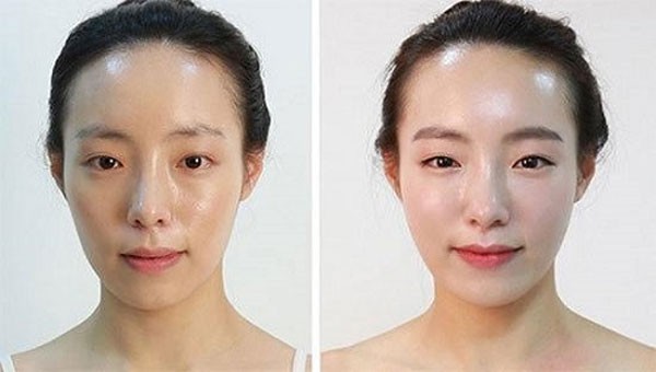 Quy trình cấy mỡ