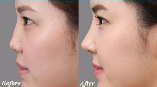 Quy trình dịch vụ phẫu thuật nâng mũi