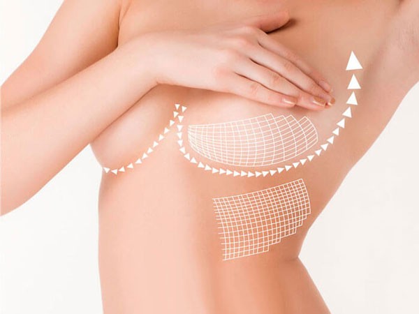 Quy trình dịch vụ phẫu thuật nâng ngực Dr Tuynh