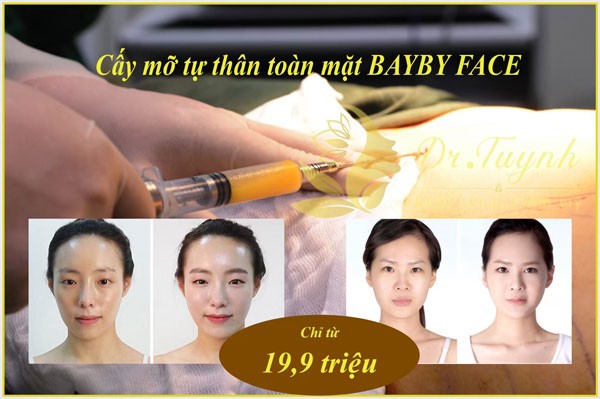 Bảng giá chi tiết dịch vụ cấy mỡ mặt 