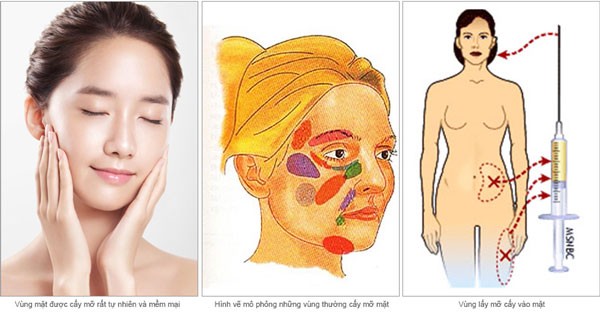 Tất tần tật những điều cần biết về cấy mỡ mặt.